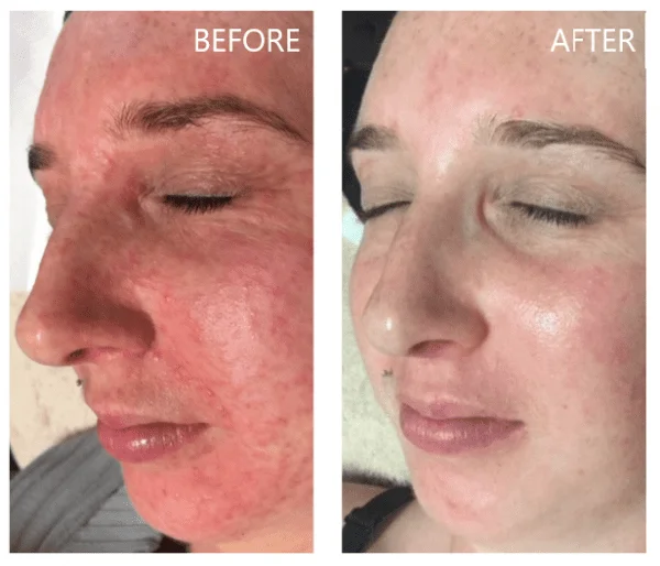 LED Facial Mask before and after